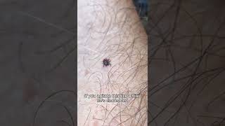 How to remove a tick with #bugbitething #tickremoval #ticks