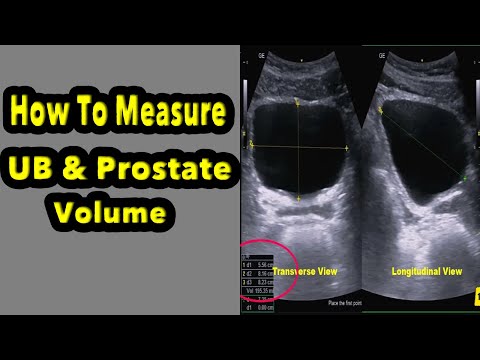 Prostate specific antigen blood test