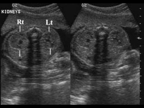 Dr Prashant Jain on Interpretation of Antenatal Hydronephrosis on USG