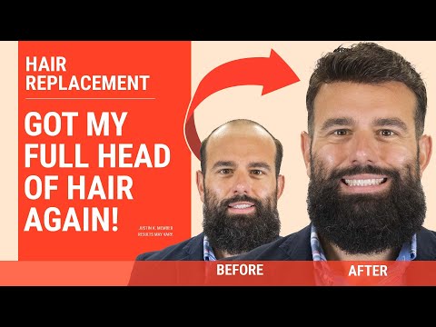 Ready to get His Hair Back! | Hair replacement before...