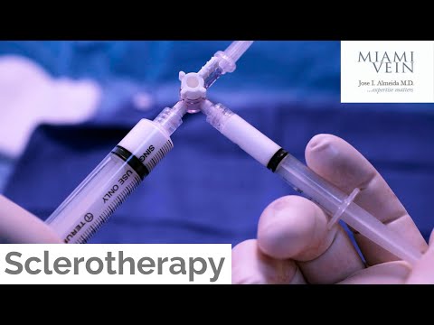 Sclerotherapy Top Things to Know by the Miami Vein Center