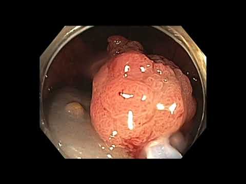 Colonoscopy: Rectal Polyp EMR - History of Hodgkins disease treated