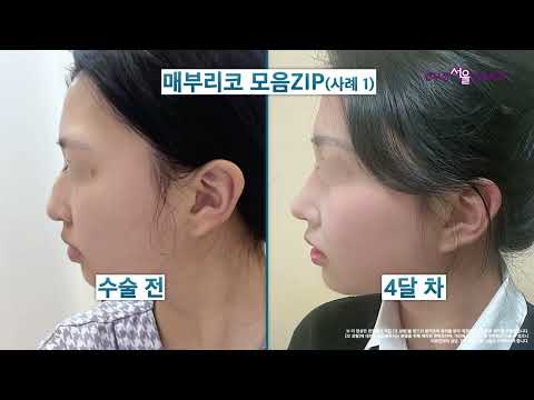 매부리코성형 전후 매끈한 코 변화 사례