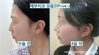 매부리코성형 전후 매끈한 코 변화 사례