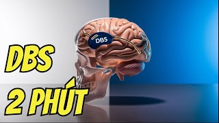 Phẫu thuật DBS cho Parkinson: Giải thích trực quan, dễ hiểu chỉ trong 2 phút