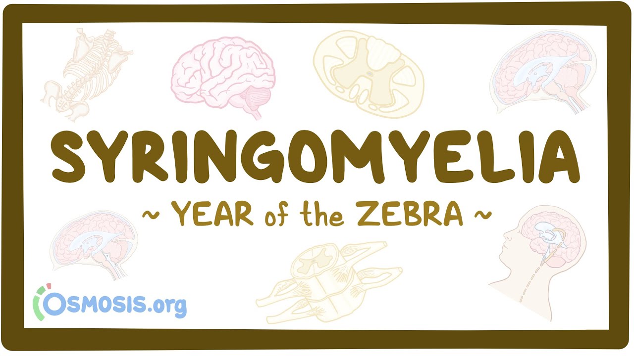 Syringomyelia (Year of the Zebra)