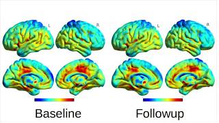 Genome-Wide Association Study of Brain Connectivity Changes for Alzheimer’s Disease, Elsheikh et al.