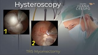 TRS Myomectomy (Scissors & Screw)