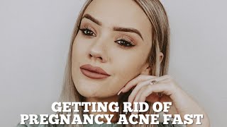 How I Cleared My Pregnancy Acne Fast + Photos
