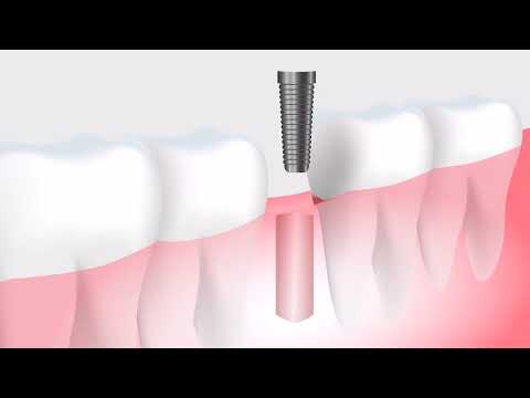 Implantes dentales