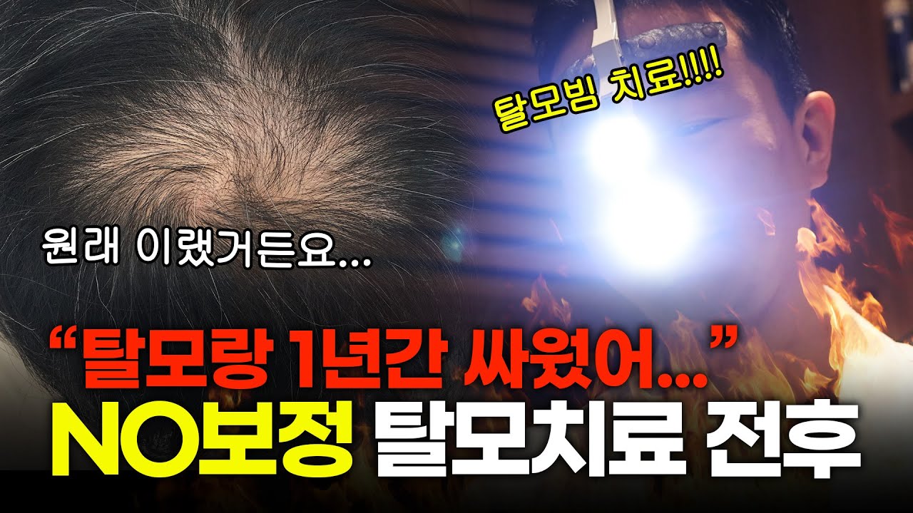 완전 NO 보정 탈모치료 1년 전후
