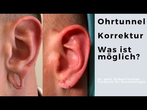 Earlobe reconstruction, Flesh tunnel zunähen
