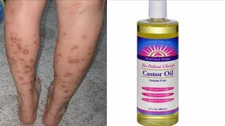 Home Remedies Series || Get Rid of Dark Spots On Legs & Body FAST With CASTOR OIL