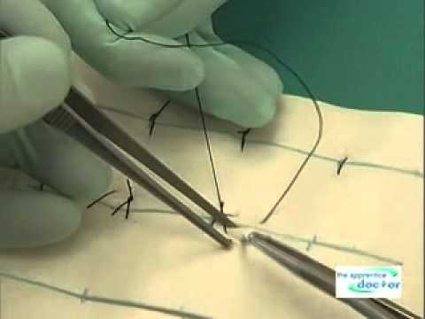Continuous Interlocking Sutures