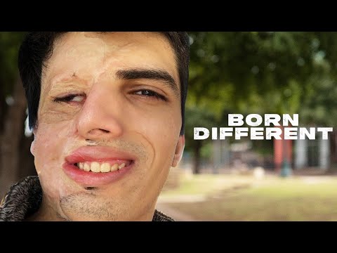 Living With 70% Burns After I Survived A House Fire | BORN DIFFERENT