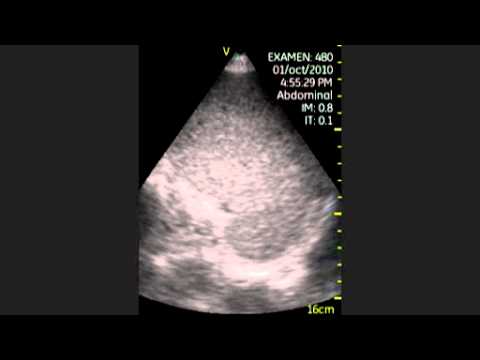 Ultrasound Image Of The Spleen In Mononucleosis