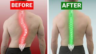 The Ultimate Guide To Fix Scoliosis - The Best Exercises For Spinal Re-Alignment