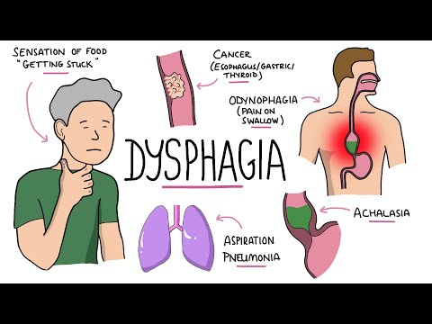 Dysphagia - Oropharyngeal & Esophageal Dysphagia (Causes/Differential Diagnosis, Signs, Treatment)
