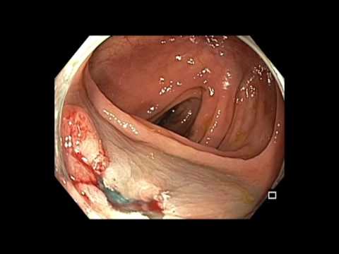 Colonoscopy: Transverse Colon EMR - Suction EMR Technique for Tethered Polyp