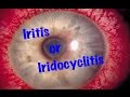 Medical Video Lecture Ophthalmology: Iridocyclitis or Iritis, Made simple