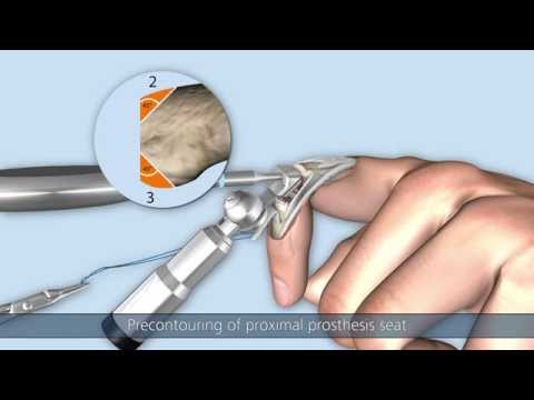 CapFlex PIP – Endoprosthetic treatment of proximal interphalangeal joint (dorsal approach)
