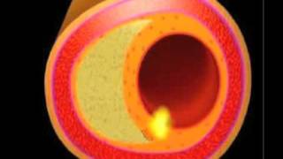 La placca aterosclerotica