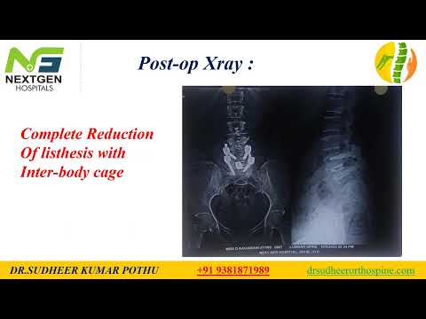 Lumbar Transforaminal Interbody Fusion for Grade II L4-L5 Lytic Anterolisthesis 