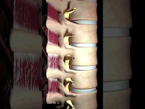 Bulging Disc Explained (Animation)