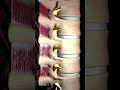 Bulging Disc Explained Animation
