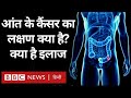 Cancer Disease आंत के कैंसर का लक्षण क्या है क्य