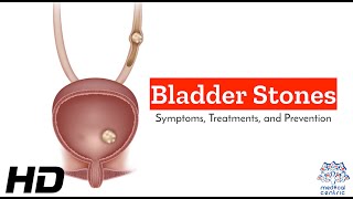 Bladder Stones : Symptoms, and Your Path to Relief