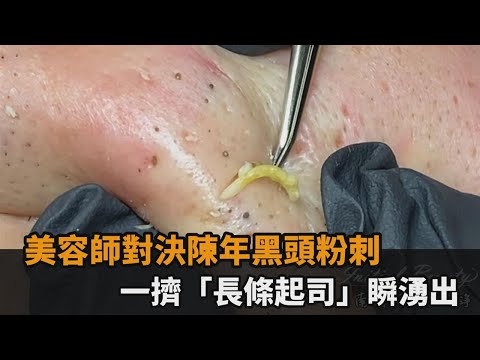 oil removal process from the skin