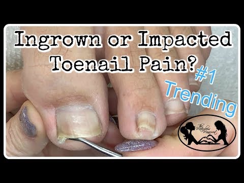 köröm és asd gomba kezelése nail gombák chage