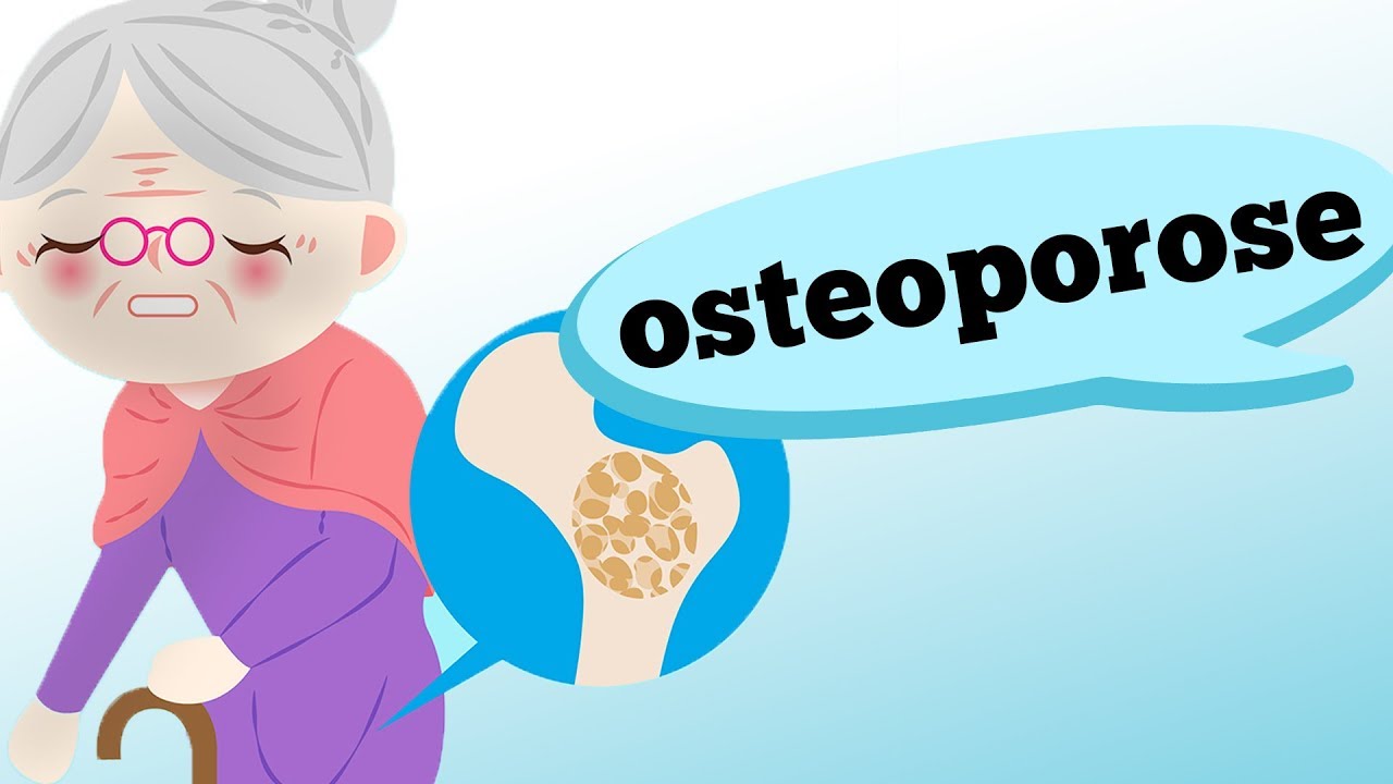 O QUE É OSTEOPOROSE? QUAIS OS SINTOMAS?