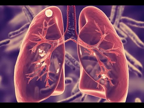 Everything you need to know about a LUNG NODULE, in 6 minutes