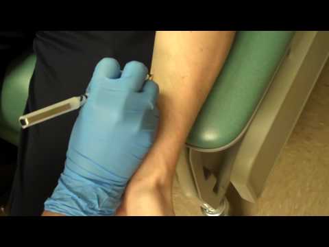 Allergy Testing Step 1, Skin Prick Testing