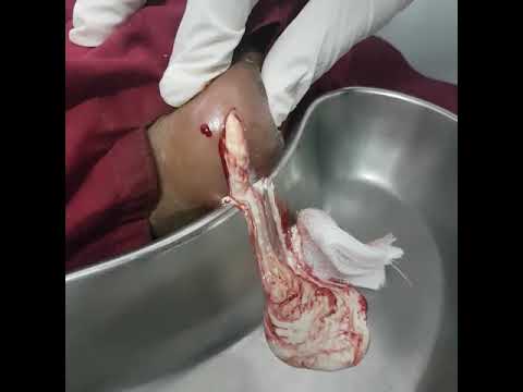 Jerawat putih kecil pada penis Meningkatkan gel glans