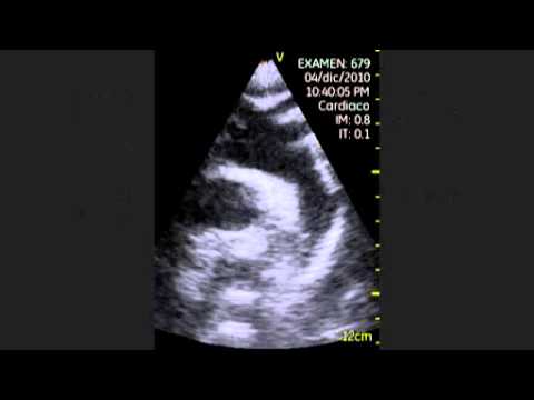 Echocardiography - Suprasternal Notch Views