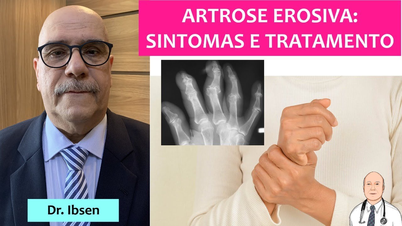 O que é artrose erosiva? Dores nos dedos das mãos com grande inflamação e destruição das juntas