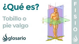 PIE VALGO | Qué es, causas, síntomas, a quién afecta y tratamiento