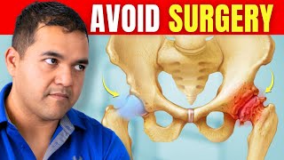 5 Powerful Tips to Avoid Hip Replacement Surgery for Bone-on-Bone Hip Arthritis