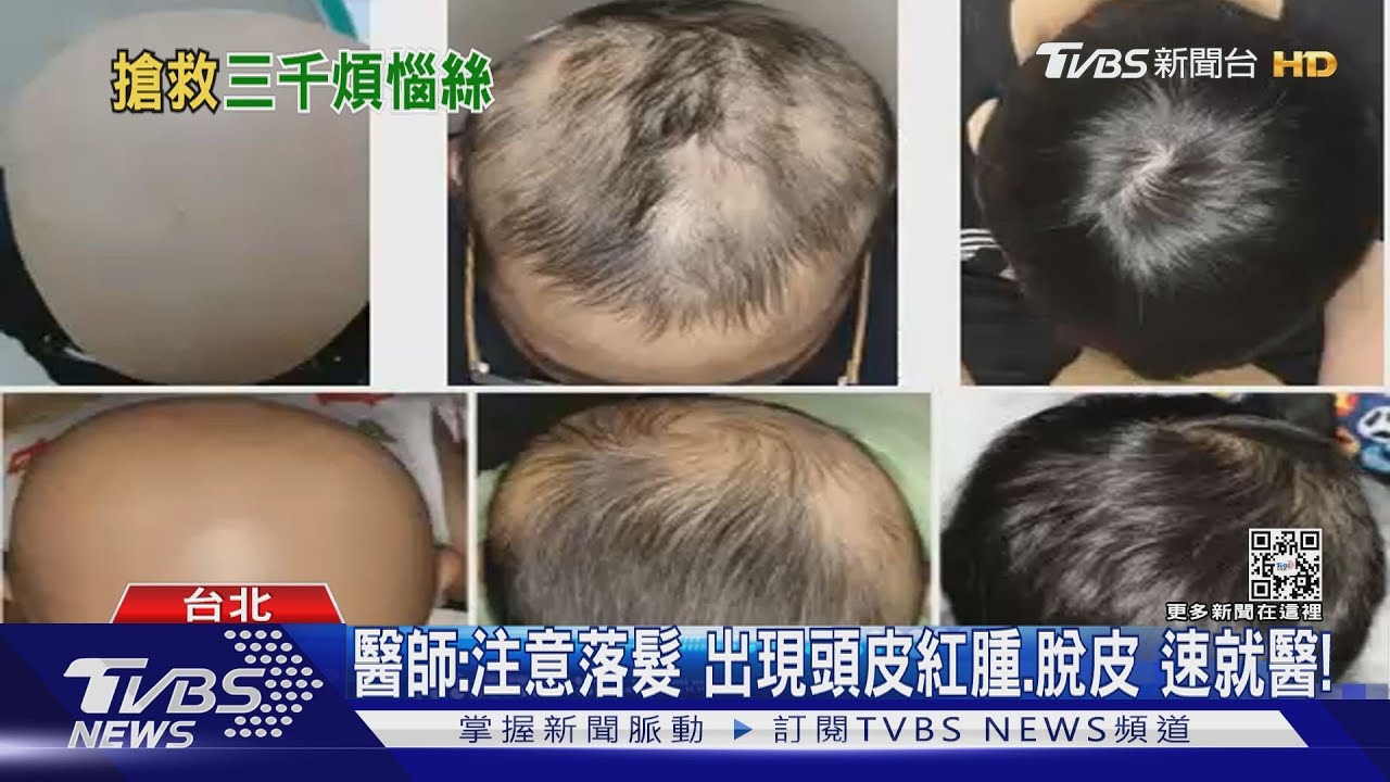頭部這處..掉髮超過100根以上...注意!鬼剃頭找上你....