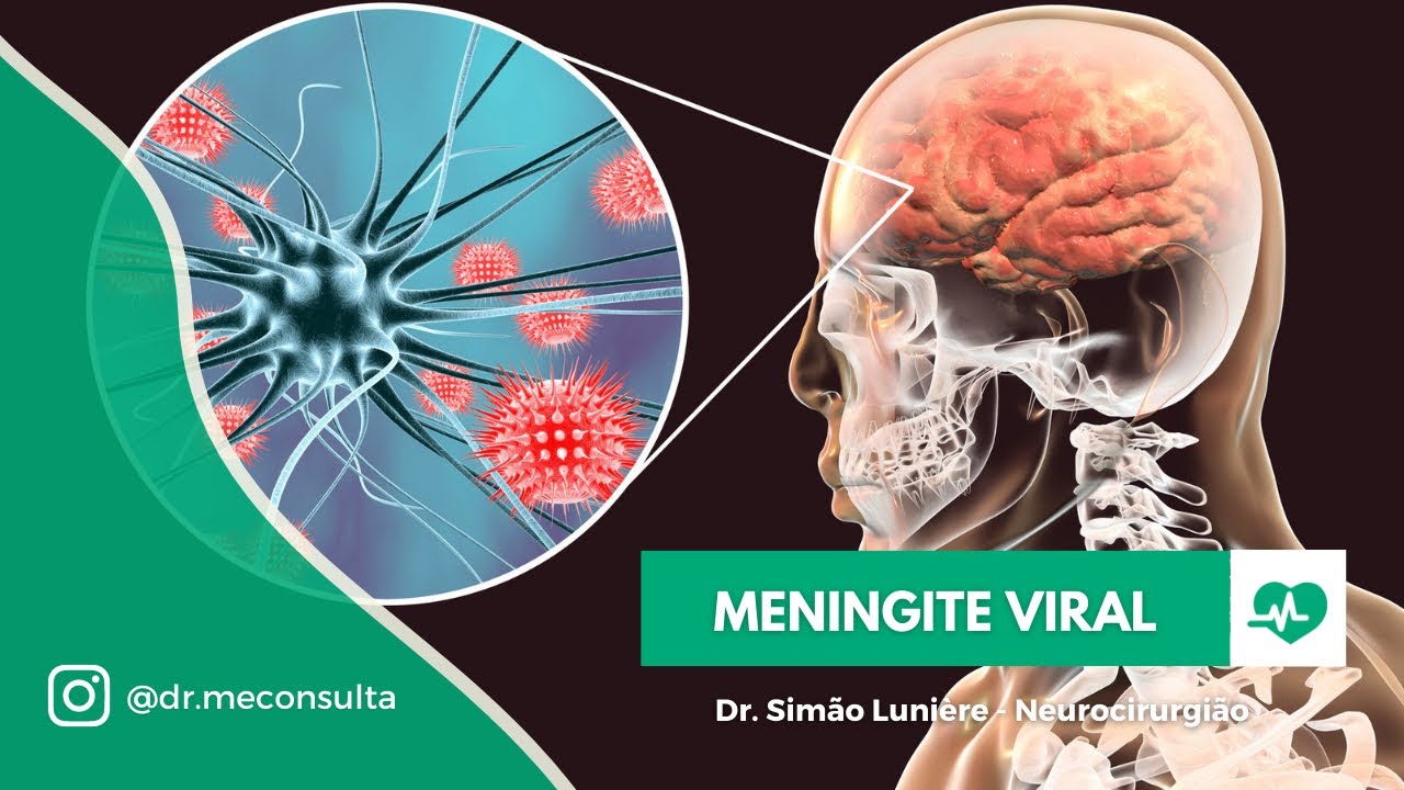 Meningite Viral: Como identificar?