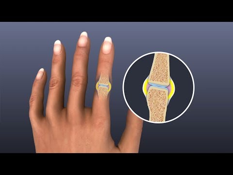 Mayo Clinic Minute: Fighting arthritis with food