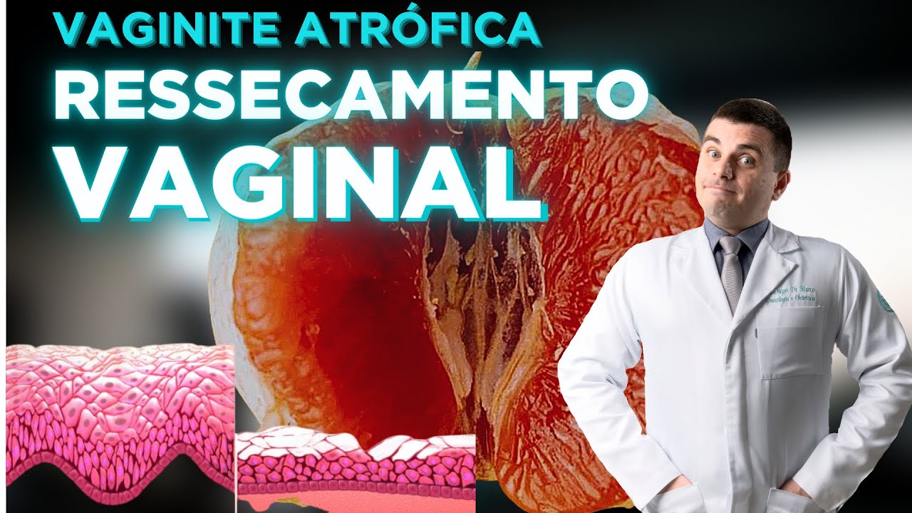 Atrophic vaginitis - Post menopausal dryness (vaginal atrophy)