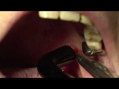 a condyloma degeneráció jelei
