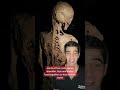 Rare medical condition called stone man syndrome, fibrodysplasia ossificans progressiva (FOP)