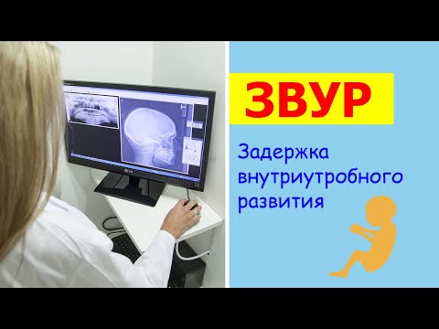 Задержка внутриутробного развития (ЗВУР)