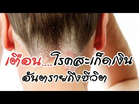 โรคสะเก็ดเงินในเส้นผมที่ ชิงจาก neurodermatitis