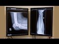 Бокс после перелома руки 